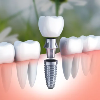A dental implant placed between natural teeth