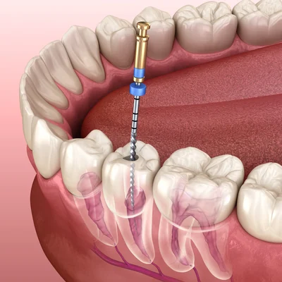 Root canal treatment illustrated