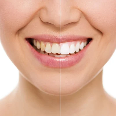 Before and after of a whitened smile