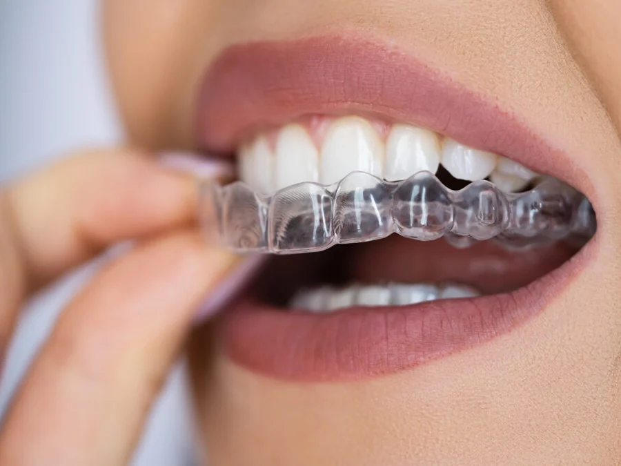 Patient fitting a clear aligner tray