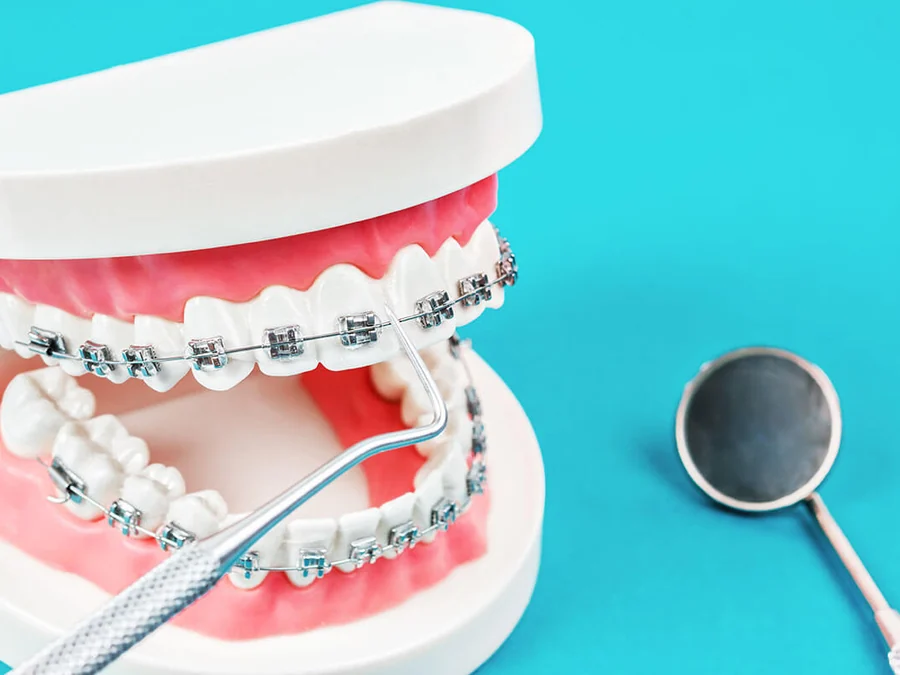 Dental model fitted with metal braces