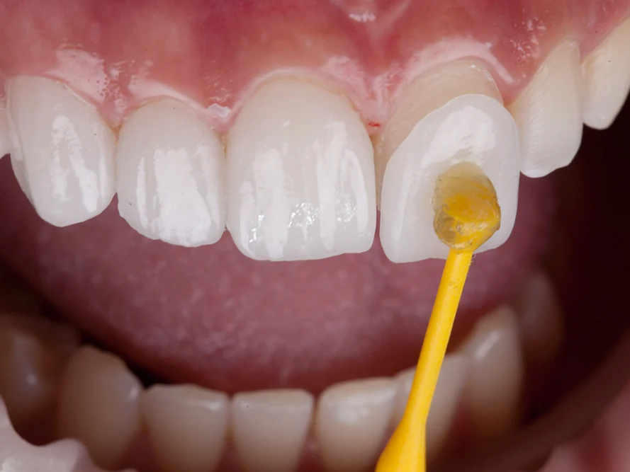 A veneer being bonded to a front tooth